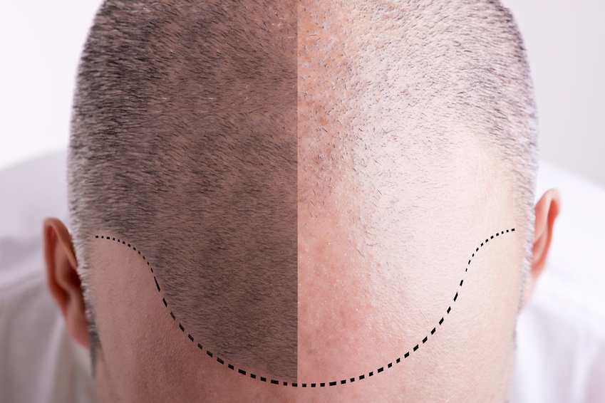 Hair Loss – Before and After