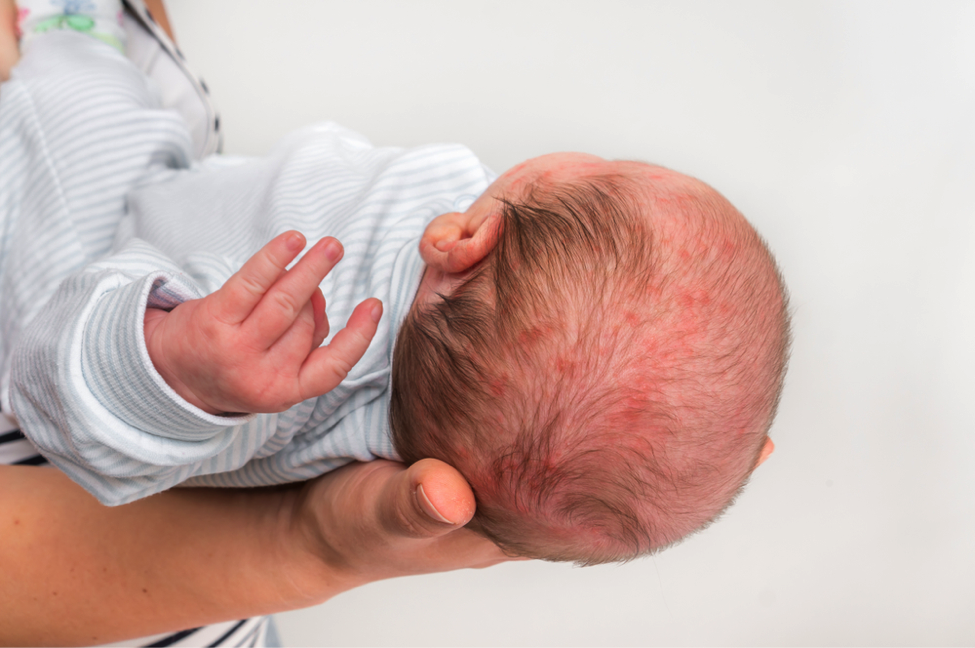 birth injury